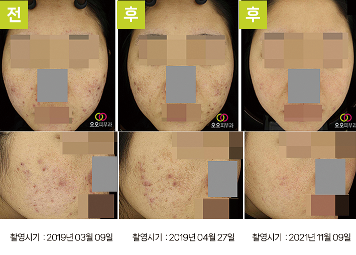 오오피부과 레이저토닝 증례 - 여드름·VSEM 증례2 UV 3시점