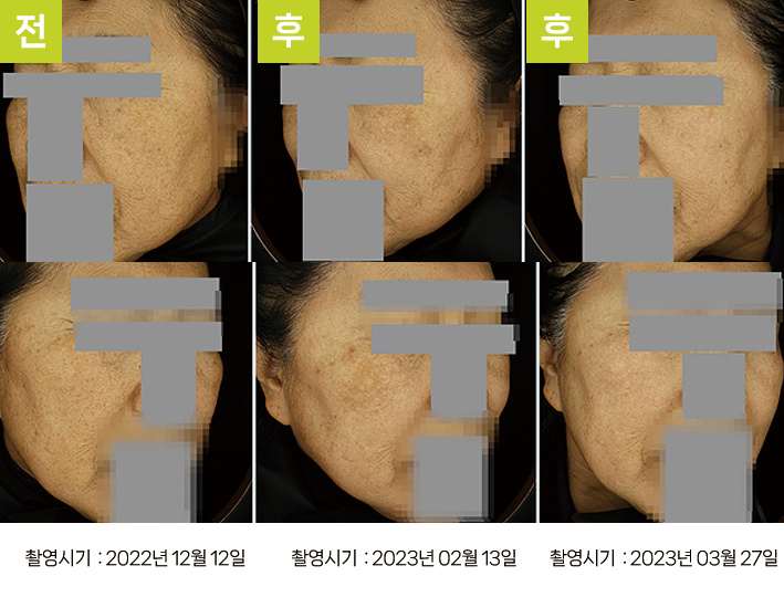 오오피부과 레이저토닝 증례 - VSEM 증례3 일반광 3시점
