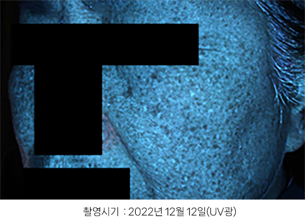 오오피부과 레이저토닝 증례 - VSEM 증례3 UV 3시점
