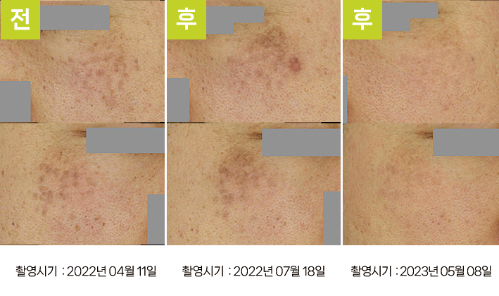 오오피부과 레이저토닝 증례 - ABNOM 색소침착 증례4 3시점