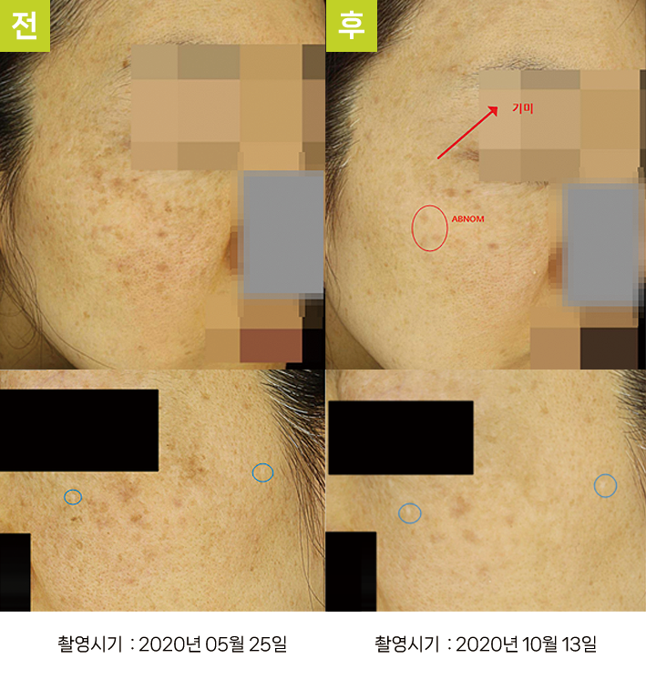 오오피부과 오타양반점 증례 - 눈가 기미·흑자증·오타양모반 증례1 전후