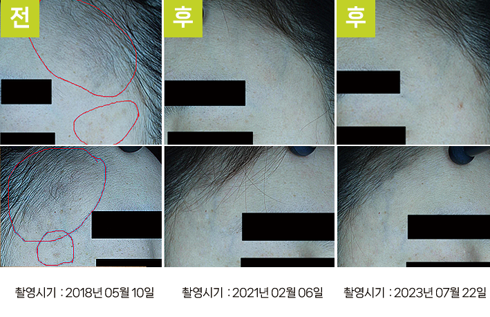 오오피부과 오타양반점 증례 - 양 이마 오타양반점 증례11 PL 전후