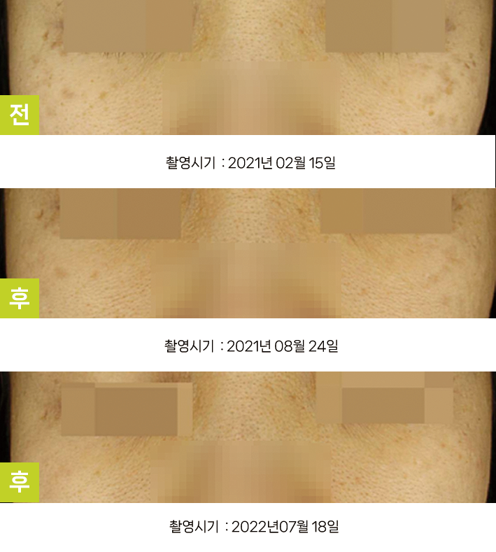 오오피부과 오타양반점 증례 - 양 광대 오타양모반 증례2 3시점
