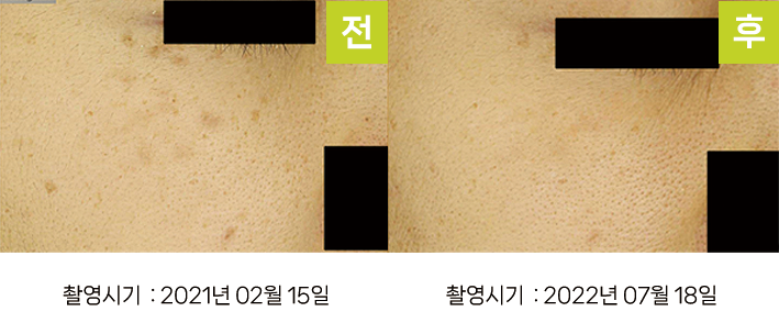오오피부과 오타양반점 증례 - 양 광대 오타양모반 증례2 UV