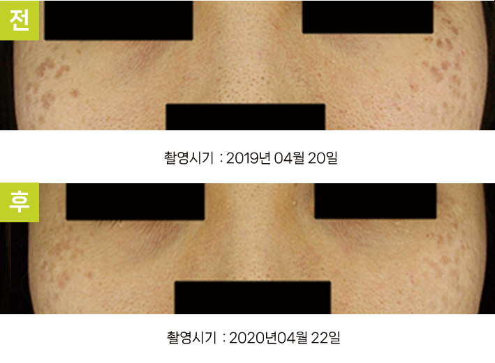 오오피부과 오타양반점 증례 - 양 광대 오타양반점 증례3 정면