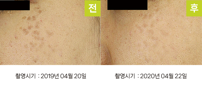 오오피부과 오타양반점 증례 - 양 광대 오타양반점 증례3 측면 전후