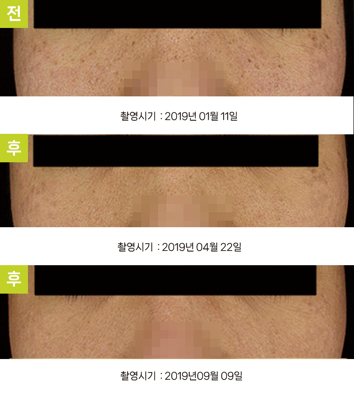 오오피부과 오타양반점 증례 - 양 광대 오타양모반 증례4 정면 3시점