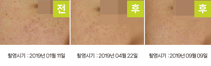 오오피부과 오타양반점 증례 - 양 광대 오타양모반 증례4 측면 3시점
