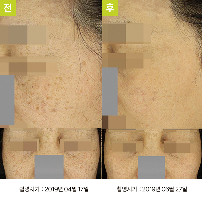 오오피부과 오타양반점 증례 - 흑자증·일광흑자·오타양모반 증례5 정면 전후