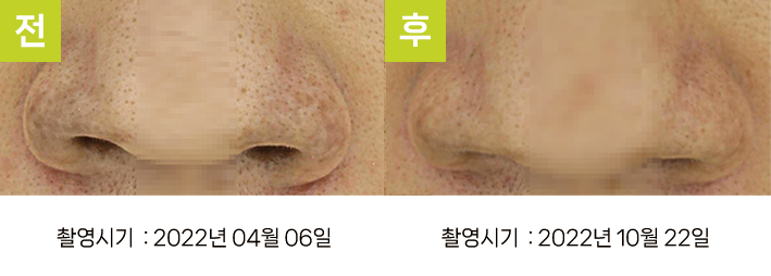 오오피부과 오타양반점 증례 - 콧망울 ABNOM 증례7 전후