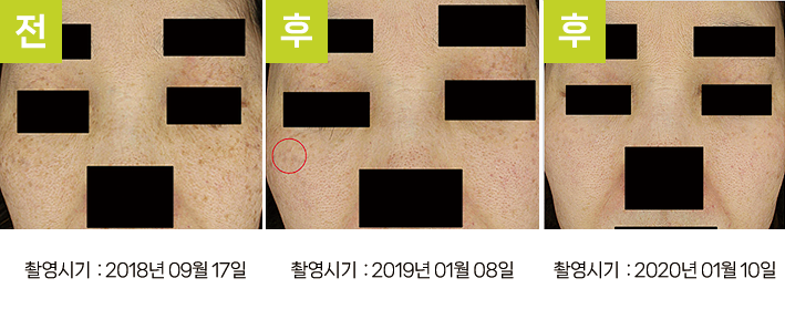 오오피부과 오타양반점 증례 - 눈가 기미·흑자증·오타양반점 증례9 3시점