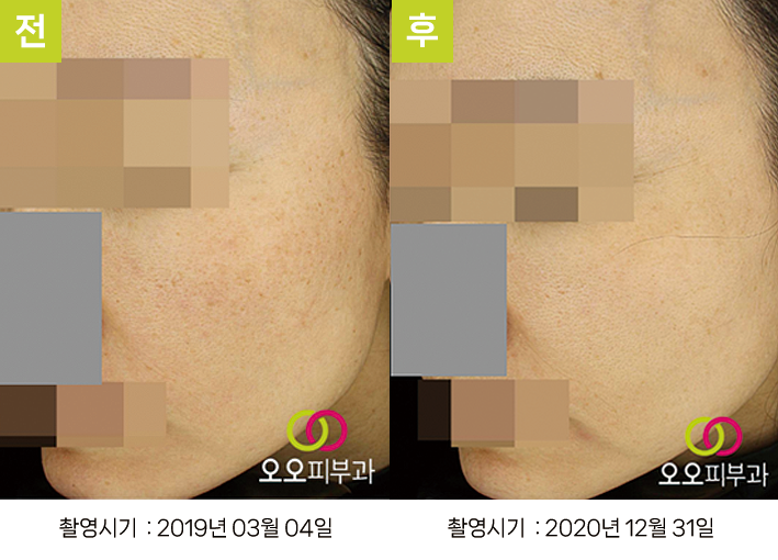 오오피부과 스킨리쥬비네이션 증례 - 증례1 측면 전후