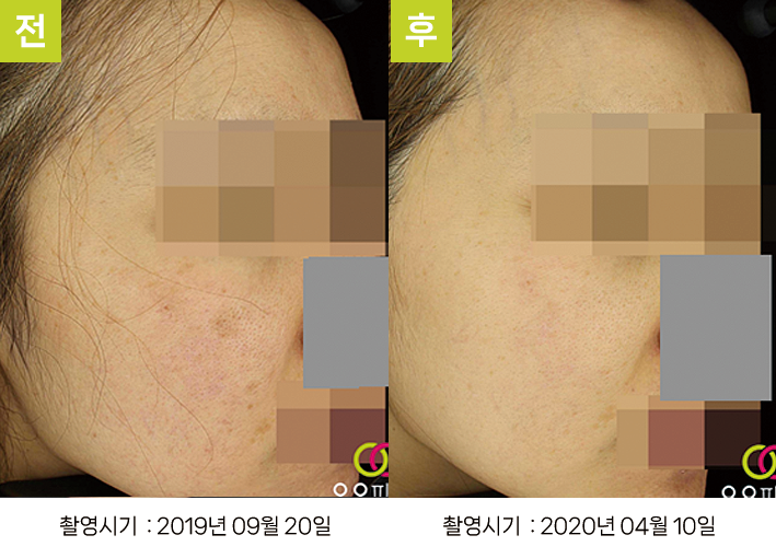 오오피부과 스킨리쥬비네이션 증례 - 증례2 측면 전후