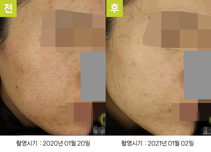 오오피부과 스킨리쥬비네이션 증례 - 증례3 측면 전후