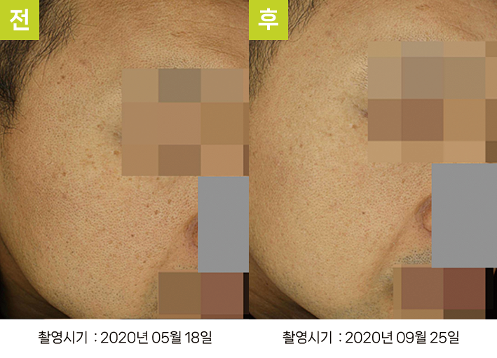 오오피부과 스킨리쥬비네이션 증례 - 증례4 측면 전후