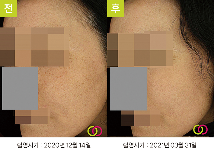 오오피부과 스킨리쥬비네이션 증례 - 증례5 측면 전후