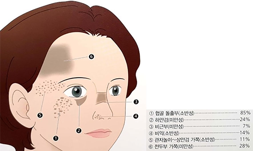 오타양반점 분포 부위 일러스트