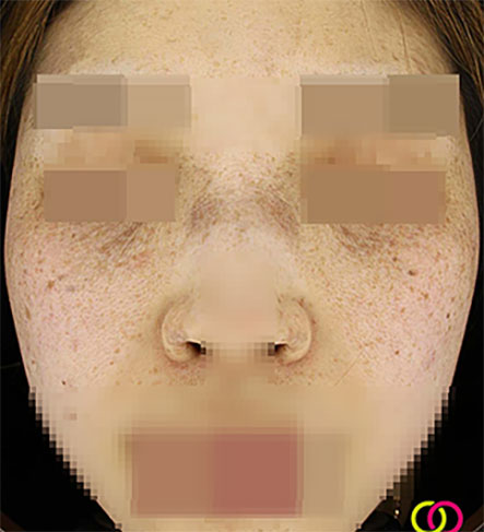 오타양반점 분포 부위 일러스트