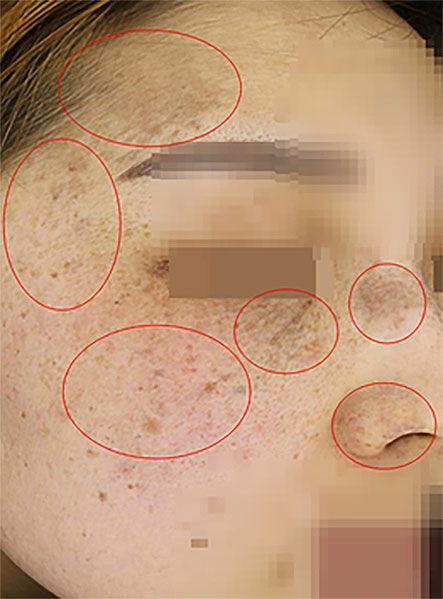 오타양반점 분포 부위 일러스트