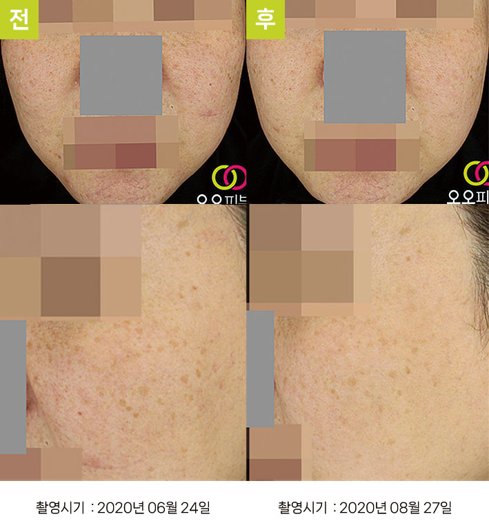 대구기미치료잘하는곳 오오피부과 - 연하고 흐린 색소 증례1, 정면 시술 전