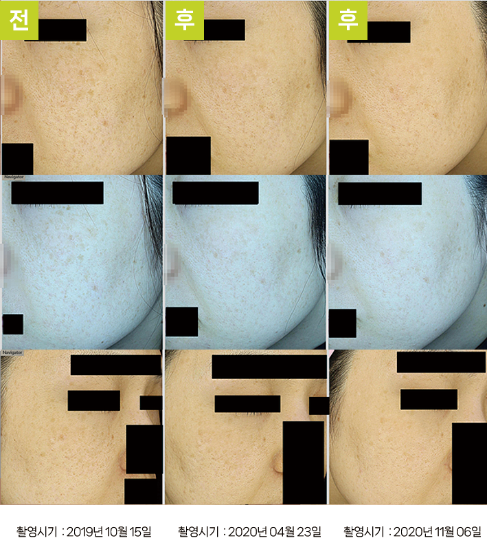 대구기미치료잘하는곳 오오피부과 - 다발성 흑자증 증례3, 측면 일반광 비교