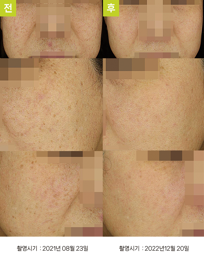 대구기미치료잘하는곳 오오피부과 - 불규칙 시술 흑자증 증례4, 정면 시술 전