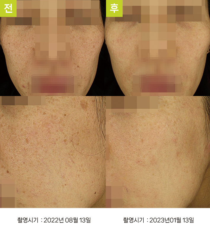 대구기미치료잘하는곳 오오피부과 - 흑자증+일광흑자 증례5, 정면 시술 전