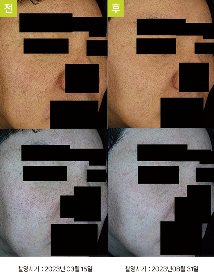 대구기미치료잘하는곳 오오피부과 - 흑자증+혈관확장성 주사 증례7, 일반광 비교