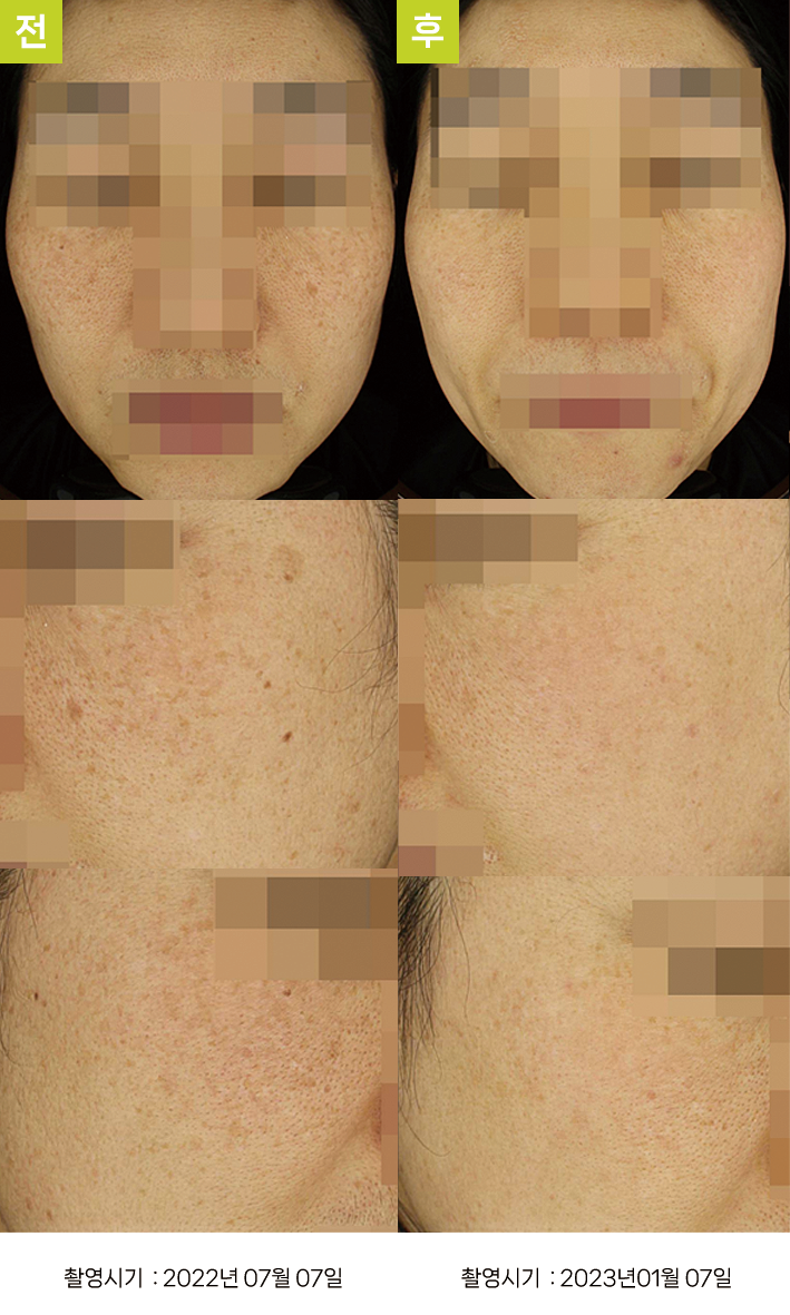 대구기미치료잘하는곳 오오피부과 - 다발성 흑자증+일광흑자 증례8, 정면 시술 전