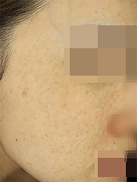 얼굴중심흑자증 예시