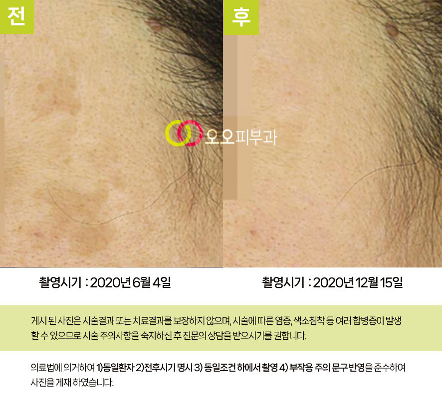 집중색소레이저 치료 전