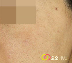 집중색소레이저 치료 후 색소 개선