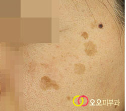 집중색소레이저 치료 전 2019년 2월