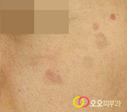 집중색소레이저 치료 중 홍반 색소침착
