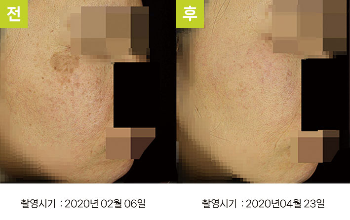 일광흑자 증례1 - 검버섯·일광흑자 복합 치료 전후