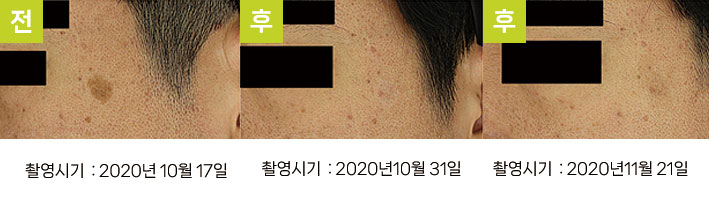 일광흑자 증례2 - 관자 일광흑자 제거 후 색소침착 경과