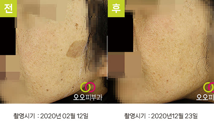 일광흑자 증례3 - 뺨 일광흑자 제거 후 유지