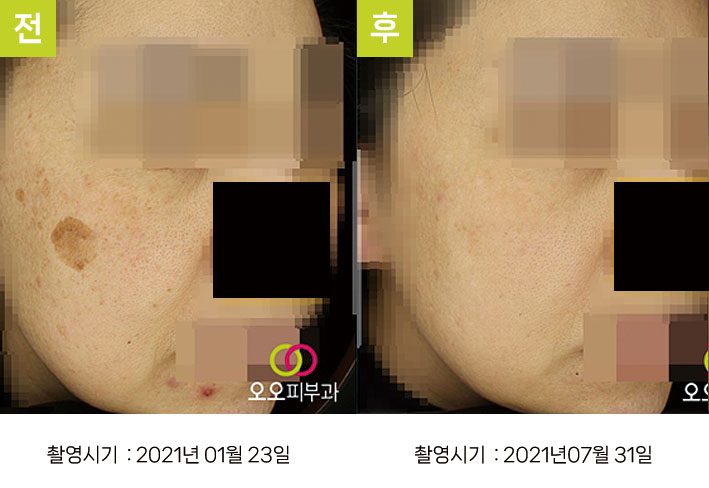 일광흑자 증례4 - 일광흑자+다발성흑자증+옅은기미 전후