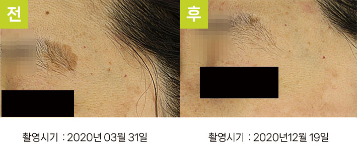 일광흑자 증례5 - 눈썹 근처 일광흑자 + 눈가 기미 전후
