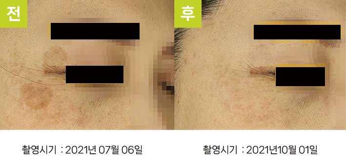 일광흑자 증례7 - 일광흑자+다발성흑자증+옅은기미 전후