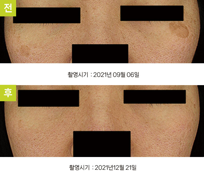 일광흑자 증례8 - 일광흑자+다발성흑자증+옅은기미 전후