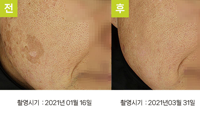 일광흑자 증례9 - 일광흑자+다발성흑자증 전후