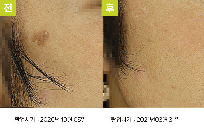 일광흑자 증례10 전후