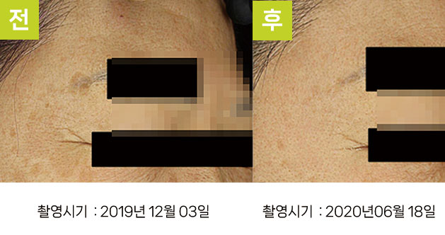 일광흑자 증례11 - 일광흑자+다발성흑자증 전후