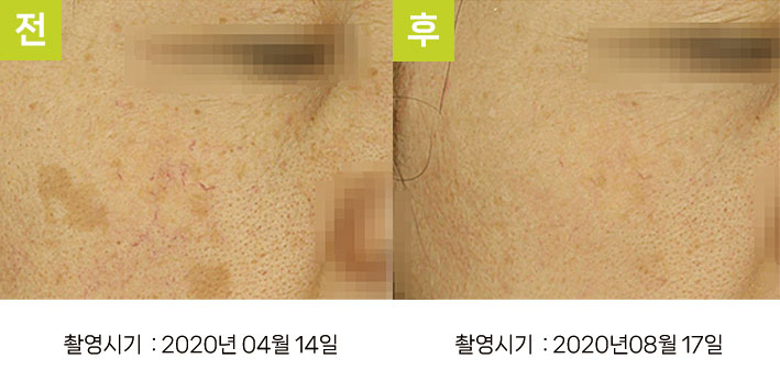 일광흑자 증례12 - 일광흑자+다발성흑자증 전후