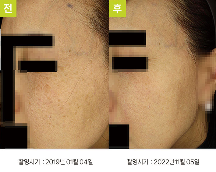 일광흑자 증례13 - 일광흑자+흑자증+기미, 스킨리쥬비네이션 효과 전후