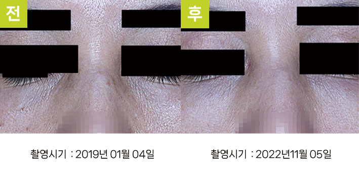 일광흑자 증례13 - 일광흑자+흑자증+기미, 스킨리쥬비네이션 효과 전후