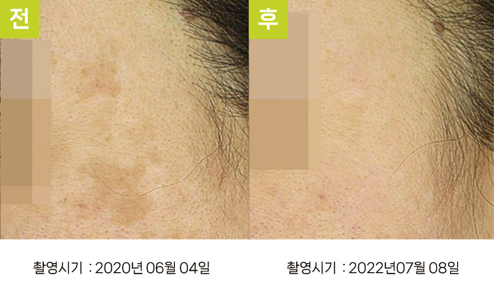 일광흑자 증례14 - 일광흑자+흑자증 전후