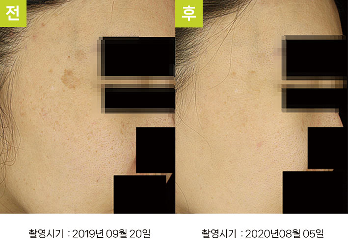 일광흑자 증례14 - 일광흑자+흑자증 전후