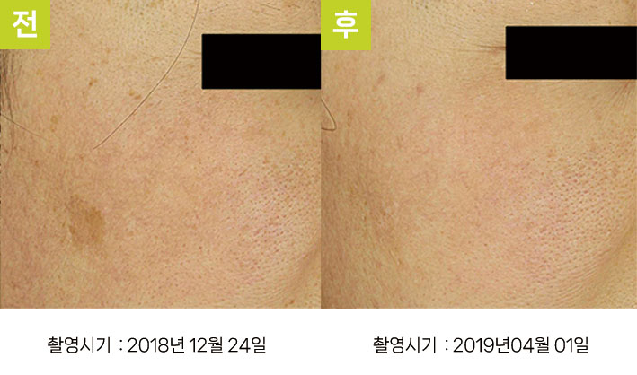 일광흑자 증례15 - 일광흑자+흑자증 전후